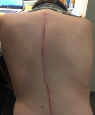 scar on back
