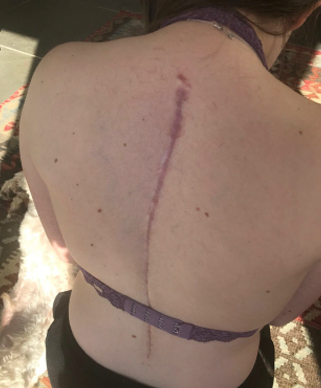 scar on back