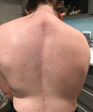 scar on back