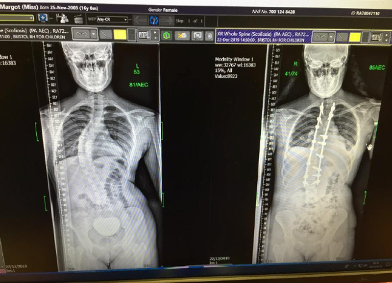 x-ray